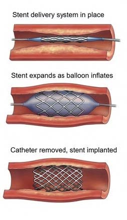 Stent